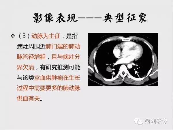 【病例】肺硬化性血管瘤1例CT影像表现与鉴别