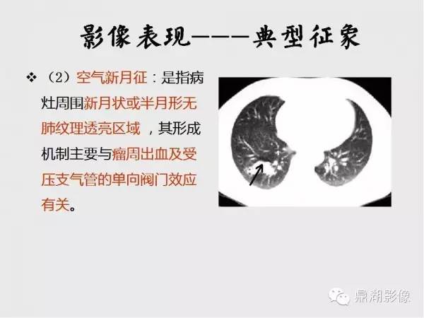 【病例】肺硬化性血管瘤1例CT影像表现与鉴别