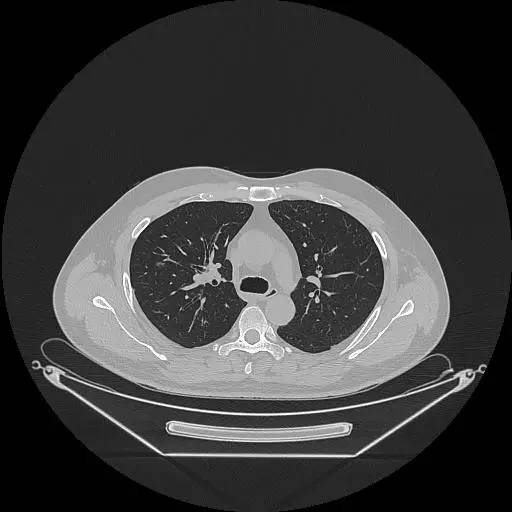 【病例】右肺上叶不典型腺瘤样增生1例CT影像表现
