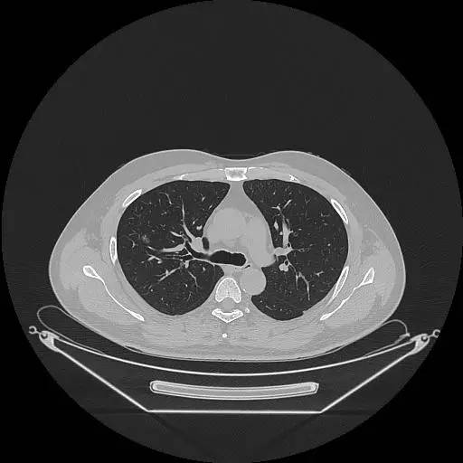 【病例】右肺上叶不典型腺瘤样增生1例CT影像表现