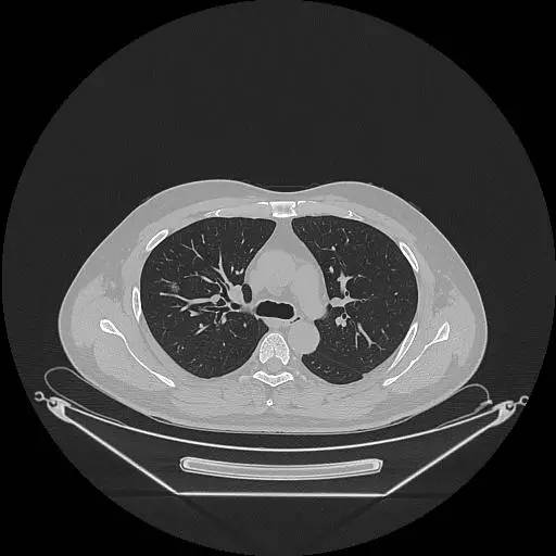 【病例】右肺上叶不典型腺瘤样增生1例CT影像表现