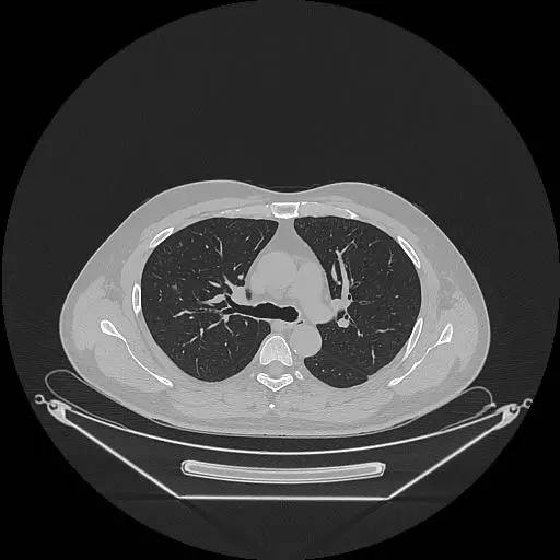【病例】右肺上叶不典型腺瘤样增生1例CT影像表现