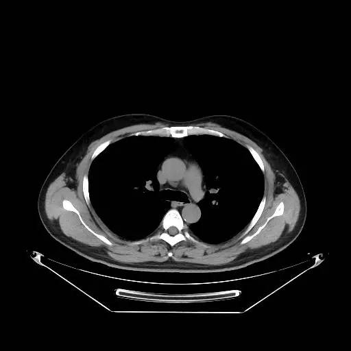 【病例】右肺上叶不典型腺瘤样增生1例CT影像表现