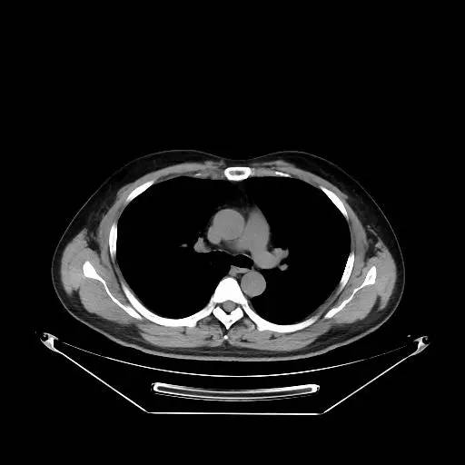 【病例】右肺上叶不典型腺瘤样增生1例CT影像表现