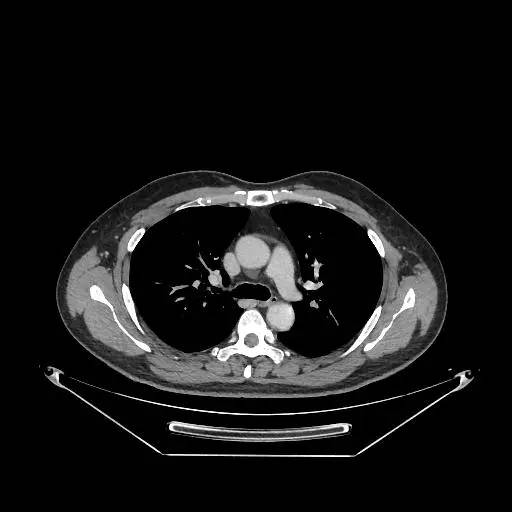 【病例】右肺上叶不典型腺瘤样增生1例CT影像表现