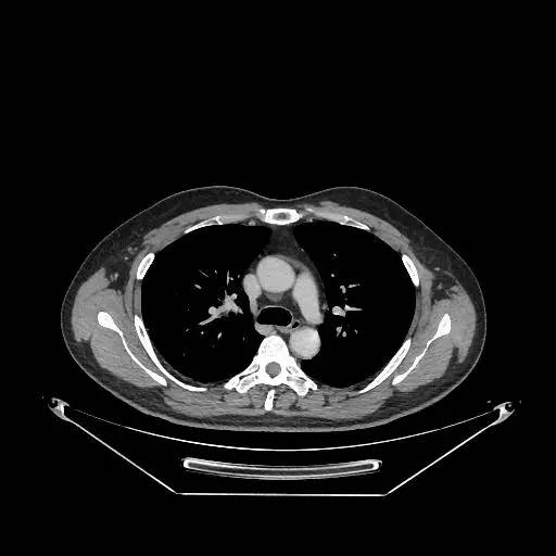 【病例】右肺上叶不典型腺瘤样增生1例CT影像表现
