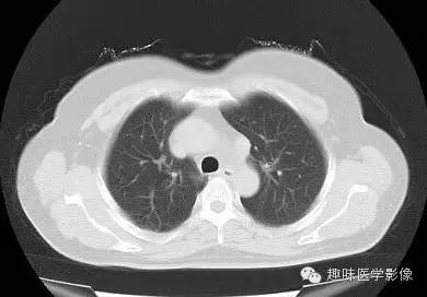 【病例】永存左上腔静脉1例CT影像表现