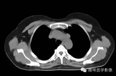 【病例】永存左上腔静脉1例CT影像表现