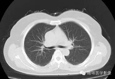 【病例】永存左上腔静脉1例CT影像表现