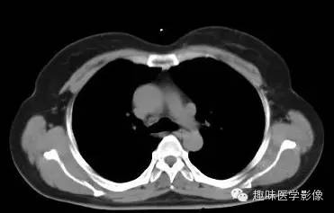 【病例】永存左上腔静脉1例CT影像表现