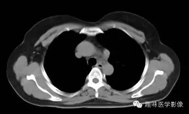 【病例】永存左上腔静脉1例CT影像表现