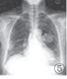 【病例】双肺多发肺动静脉瘘1例CT影像表现