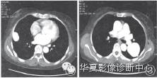 【病例】双肺多发肺动静脉瘘1例CT影像表现
