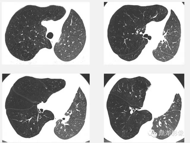 【PPT】肺内多发空洞和囊性病变诊断与鉴别诊断