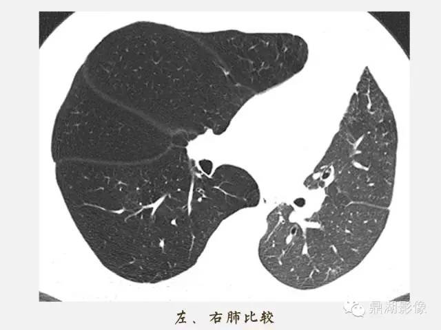 【PPT】肺内多发空洞和囊性病变诊断与鉴别诊断