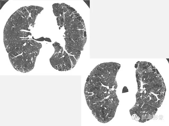 【PPT】肺内多发空洞和囊性病变诊断与鉴别诊断