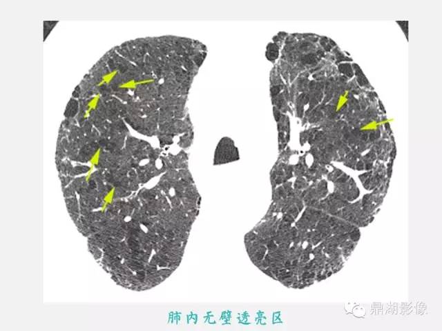 【PPT】肺内多发空洞和囊性病变诊断与鉴别诊断