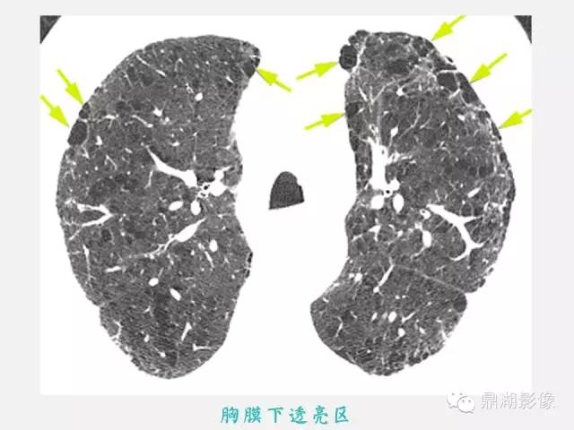 【PPT】肺内多发空洞和囊性病变诊断与鉴别诊断