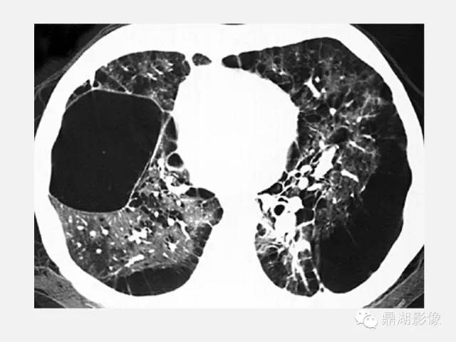 【PPT】肺内多发空洞和囊性病变诊断与鉴别诊断