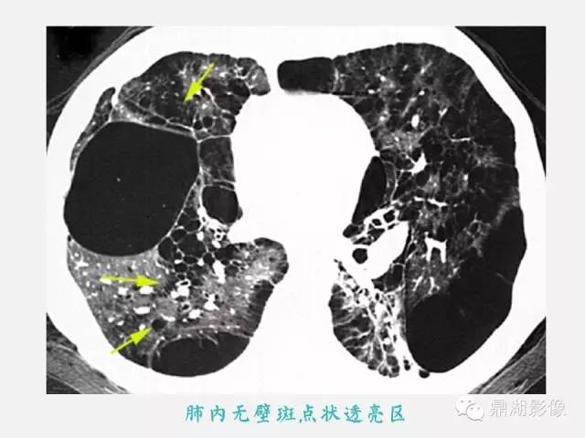【PPT】肺内多发空洞和囊性病变诊断与鉴别诊断