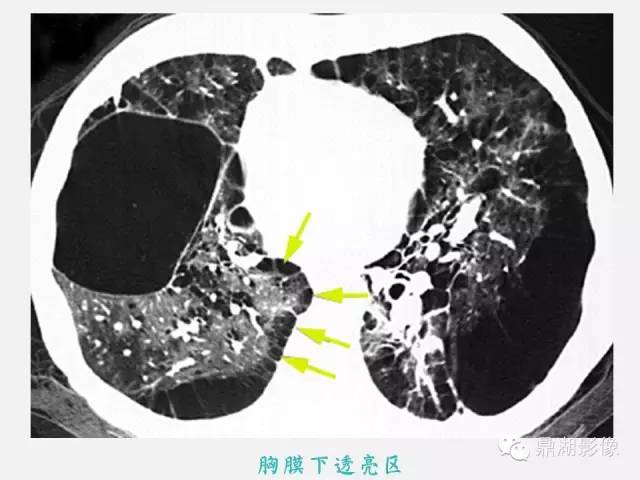 【PPT】肺内多发空洞和囊性病变诊断与鉴别诊断