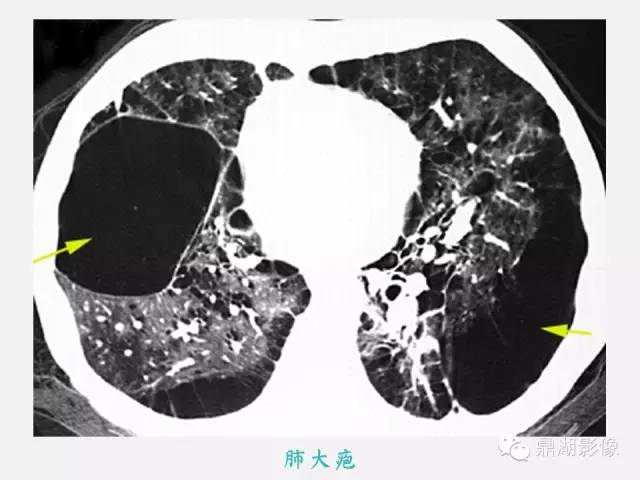 【PPT】肺内多发空洞和囊性病变诊断与鉴别诊断