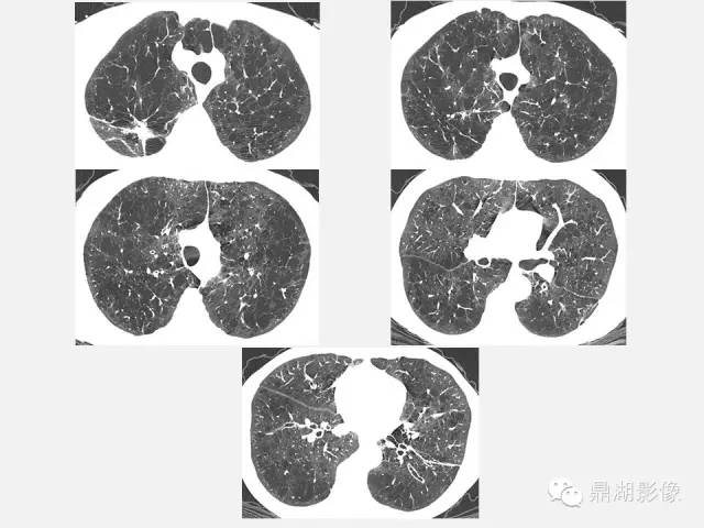 【PPT】肺内多发空洞和囊性病变诊断与鉴别诊断