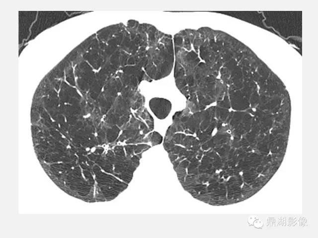 【PPT】肺内多发空洞和囊性病变诊断与鉴别诊断