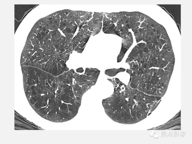 【PPT】肺内多发空洞和囊性病变诊断与鉴别诊断