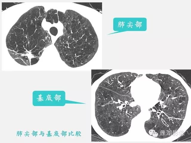 【PPT】肺内多发空洞和囊性病变诊断与鉴别诊断