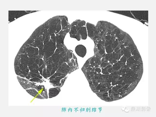 【PPT】肺内多发空洞和囊性病变诊断与鉴别诊断
