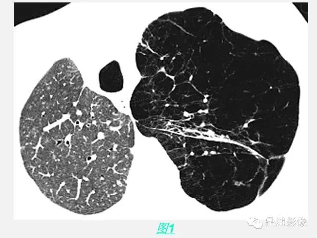 【PPT】肺内多发空洞和囊性病变诊断与鉴别诊断