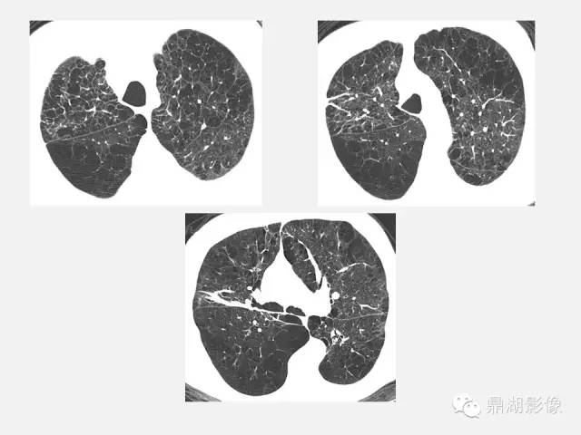 【PPT】肺内多发空洞和囊性病变诊断与鉴别诊断