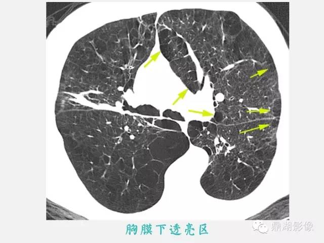 【PPT】肺内多发空洞和囊性病变诊断与鉴别诊断
