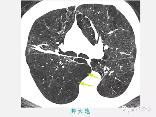【PPT】肺内多发空洞和囊性病变诊断与鉴别诊断