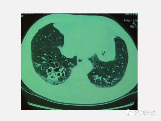 【PPT】肺内多发空洞和囊性病变诊断与鉴别诊断