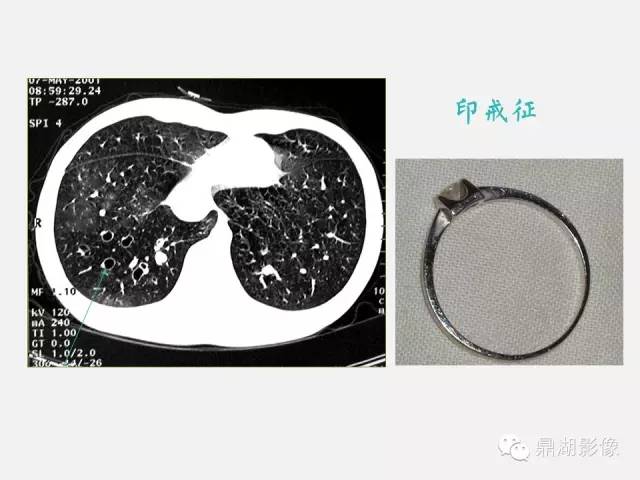 【PPT】肺内多发空洞和囊性病变诊断与鉴别诊断