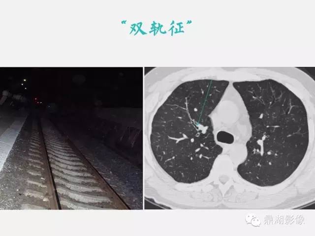 【PPT】肺内多发空洞和囊性病变诊断与鉴别诊断