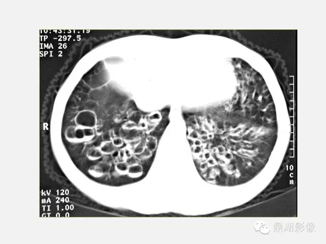 【PPT】肺内多发空洞和囊性病变诊断与鉴别诊断