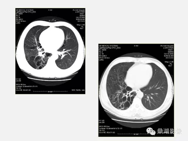 【PPT】肺内多发空洞和囊性病变诊断与鉴别诊断