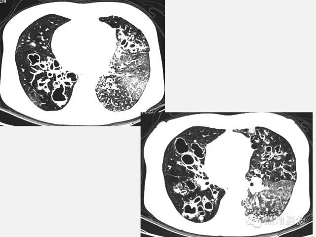 【PPT】肺内多发空洞和囊性病变诊断与鉴别诊断