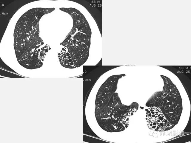 【PPT】肺内多发空洞和囊性病变诊断与鉴别诊断