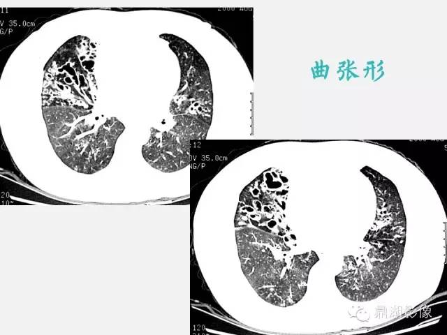 【PPT】肺内多发空洞和囊性病变诊断与鉴别诊断