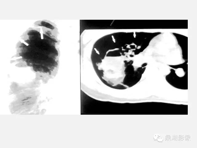 【PPT】肺内多发空洞和囊性病变诊断与鉴别诊断