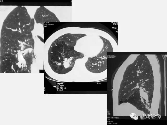 【PPT】肺内多发空洞和囊性病变诊断与鉴别诊断
