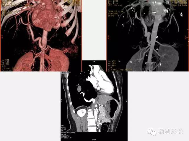 【PPT】肺内多发空洞和囊性病变诊断与鉴别诊断