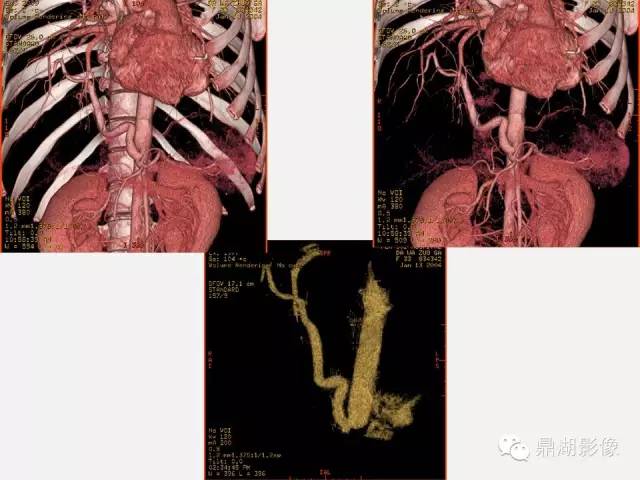 【PPT】肺内多发空洞和囊性病变诊断与鉴别诊断