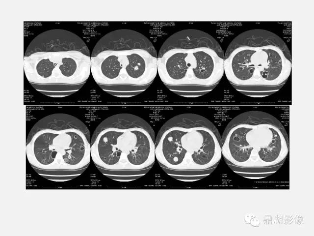 【PPT】肺内多发空洞和囊性病变诊断与鉴别诊断