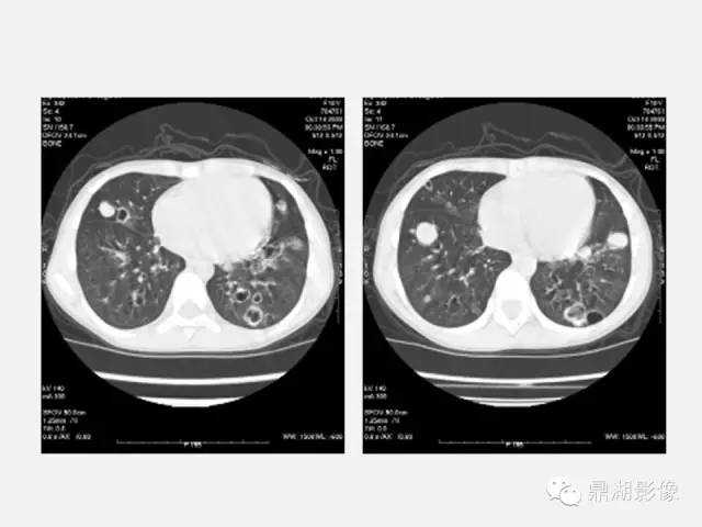 【PPT】肺内多发空洞和囊性病变诊断与鉴别诊断