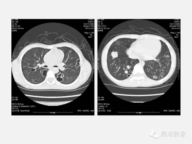 【PPT】肺内多发空洞和囊性病变诊断与鉴别诊断